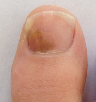 ongle-podiatre-mirabel-ste-therese-10-petit.png