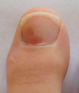 ongle-brun-podiatre-mirabel-ste-therese2.png