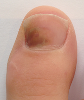 ongle-podiatre-mirabel-ste-therese-11-petit.png
