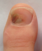 ongle-podiatre-mirabel-ste-therese-12-petit.png