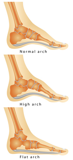 arche-pieds-plats-podiatre-mirabel-ste-therese.jpg