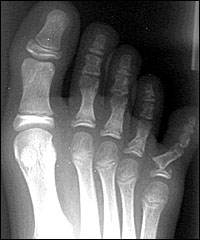 fracture-orteil-podiatre-mirabel-sainte-ste-therese.jpg