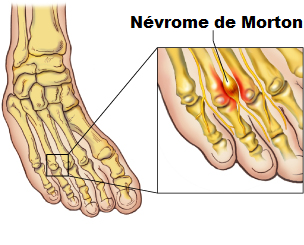 Nevrome de Morton