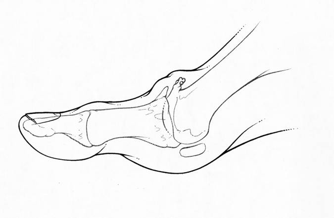 podiatre-mirabel-ste-therese-Hallux-rigidus.jpg