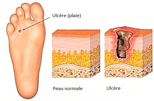 ulcère diabétique