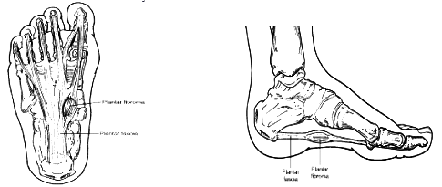 Fibrome plantaire, fibromatose plantaire