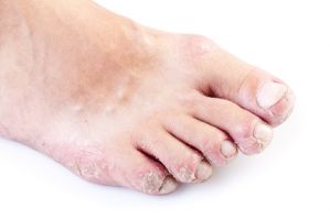 Eczéma, dermatite aux pieds Podiatre Mirabel Ste-Thérèse